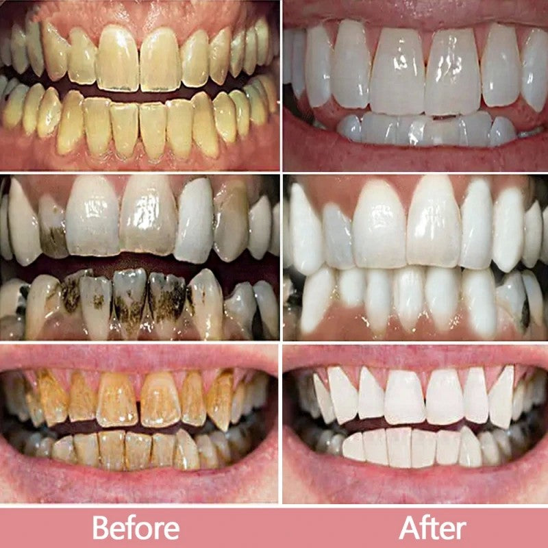 BrightSmile [V34]® - Clareamento Dental