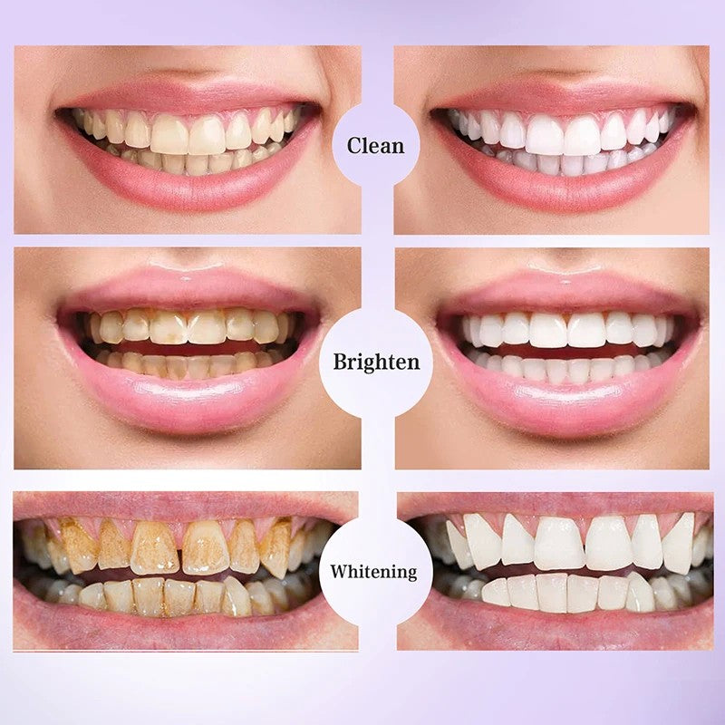 BrightSmile [V34]® - Clareamento Dental