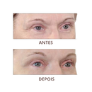 Removedor de Rugas FIRM-A-TITE™