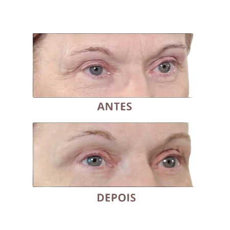 Removedor de Rugas FIRM-A-TITE™